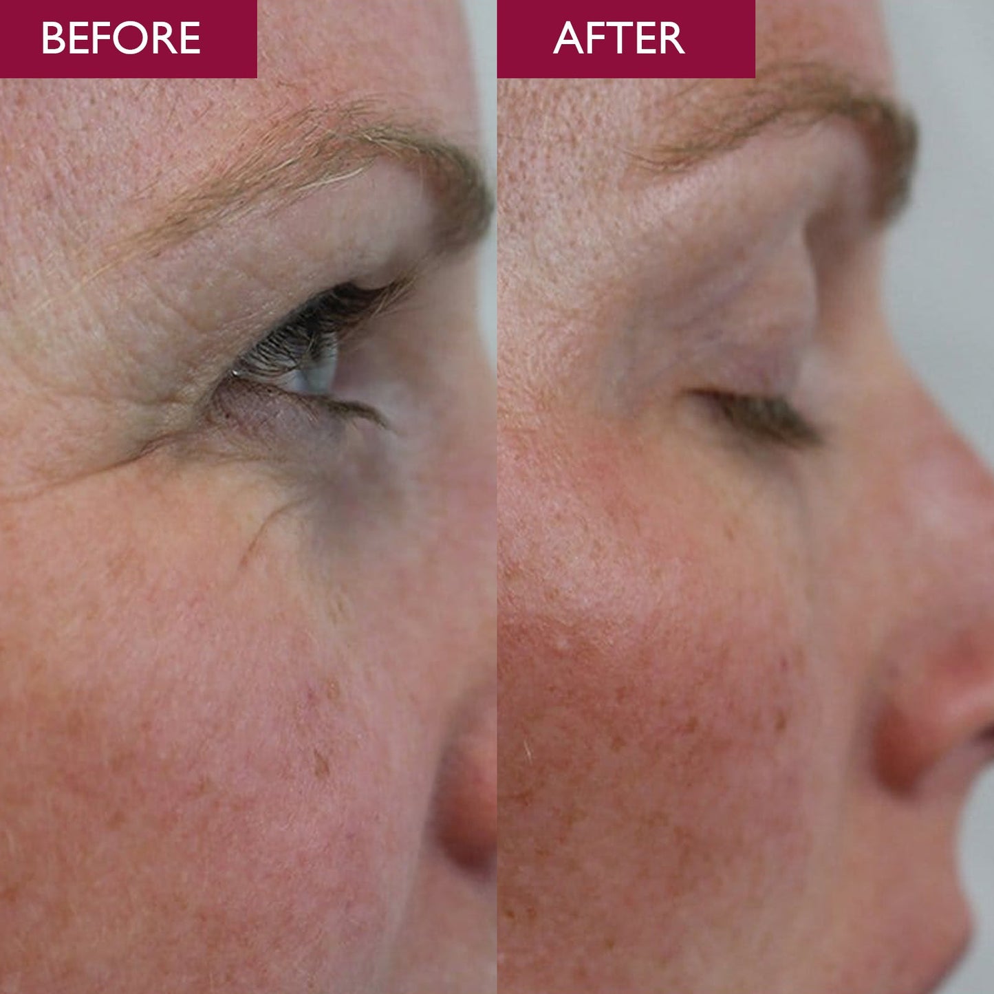 A before and after picture of a lady with wrinkles and darkness under the eye area.  After photo shows no wrinkles and a brighter under eye from using Skinician shea butter eye cream.