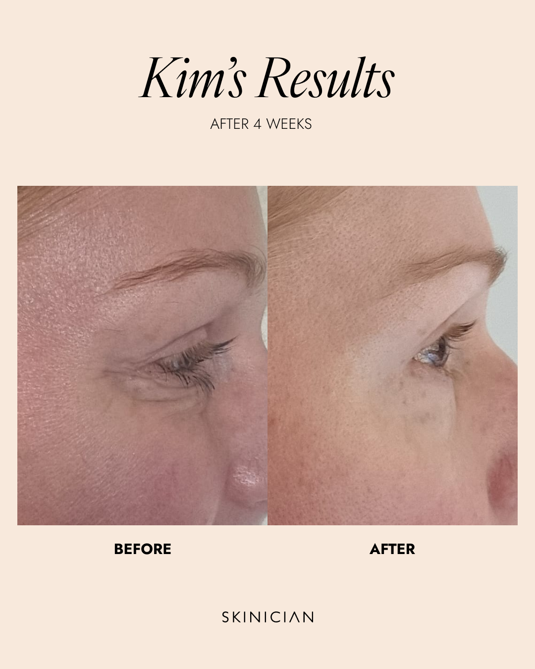 Before and after comparison of skin treatment after 4 weeks using Peptide Eye Complex