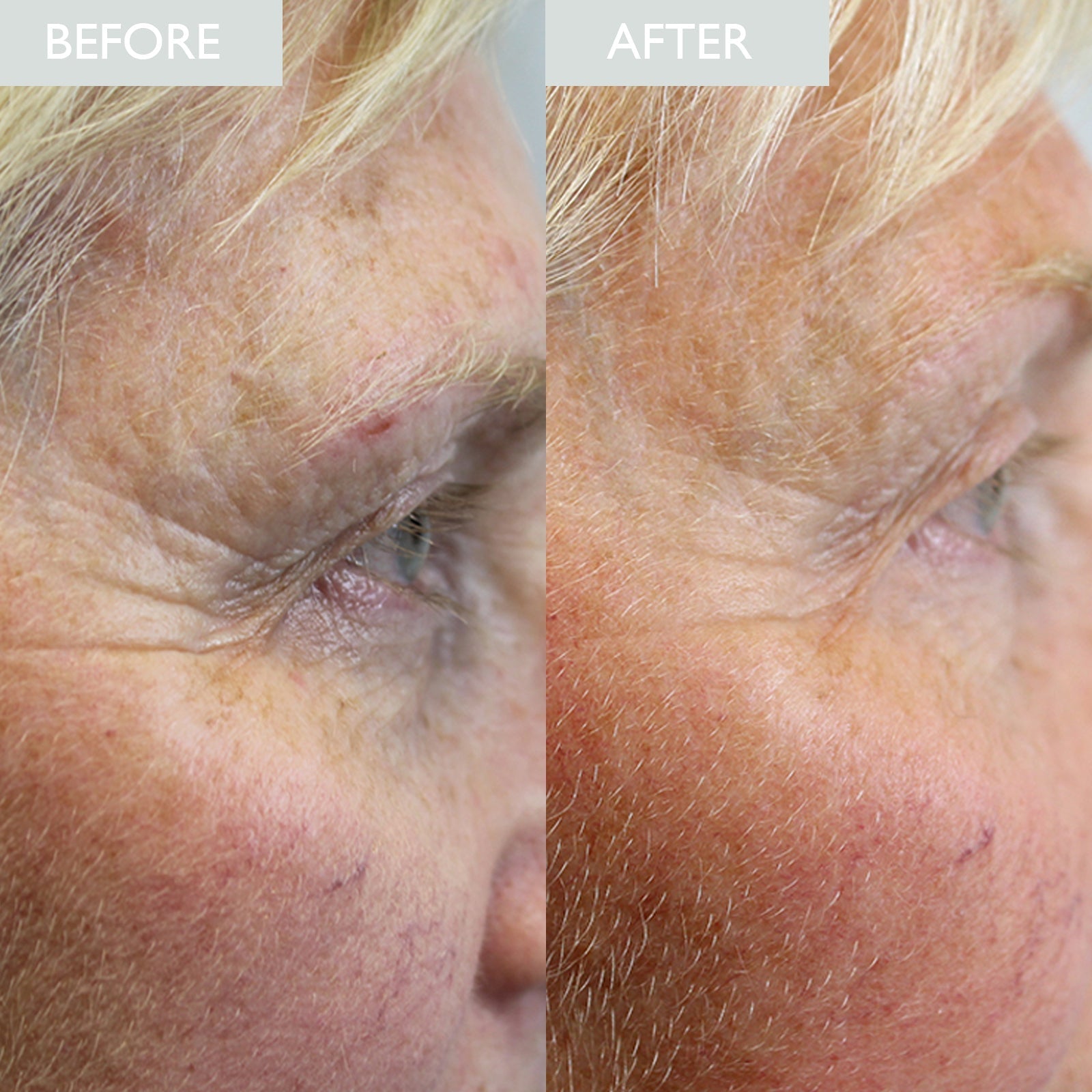Before and After image showing an improvement in fine lines around the eye area with peptide eye cream