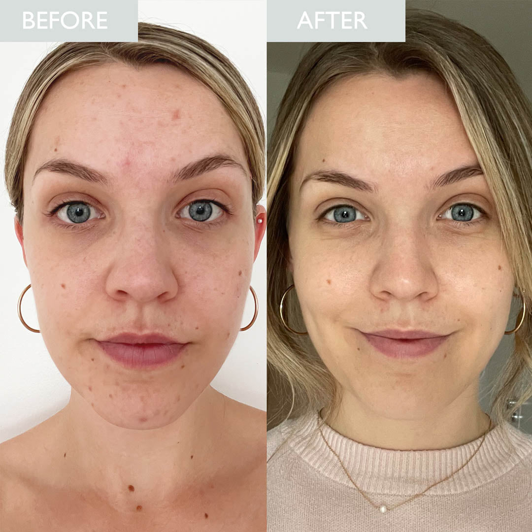Before and After image of a women with hormonal breakouts.  Improvement and clarity can be seen on the after photo with less breakouts showing.