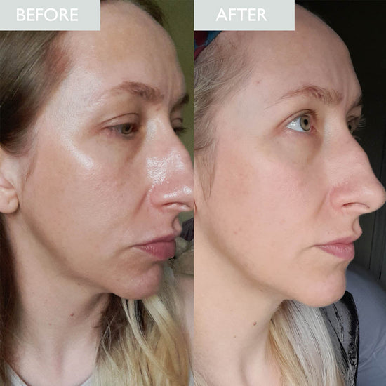 Before and after of a lady with oily shiny skin.  Improvement can be seen in the after photo.  Mattified skin appearance and less pores are visible.