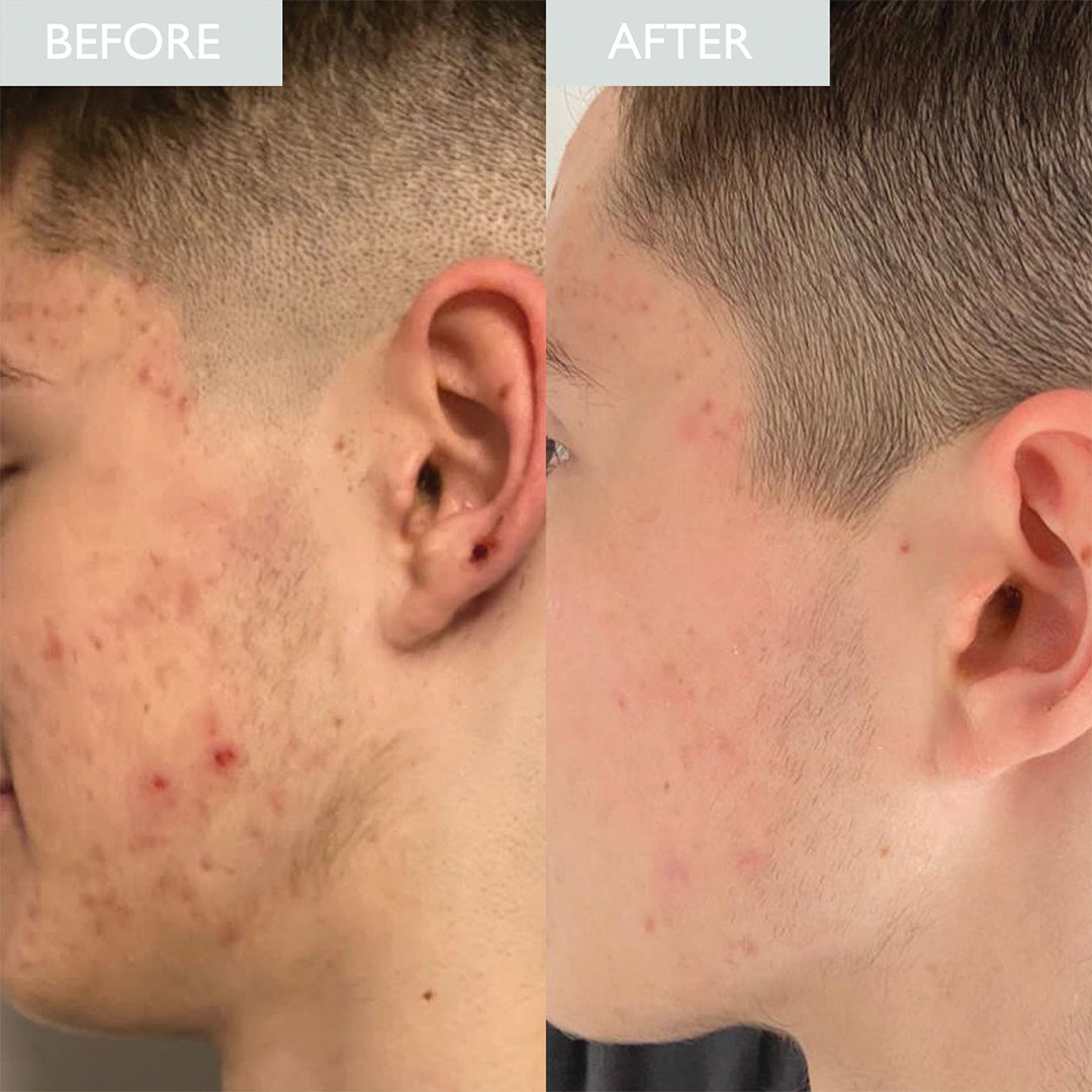 A before and after of a male with breakouts and improved clarity after using Skinicians purifying face wash.