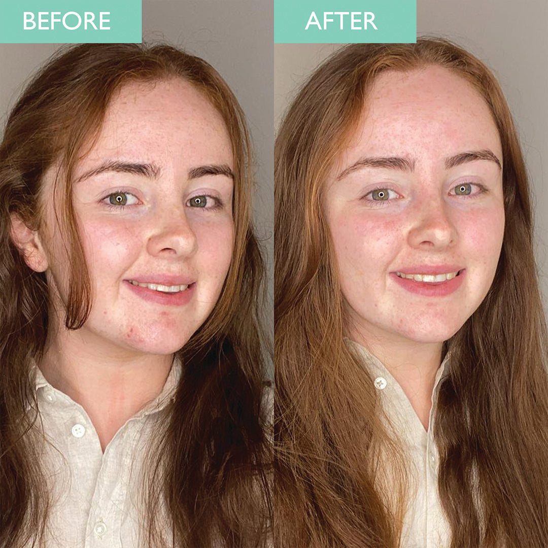 Before and after of a young later showing brighter less oily skin after using the purifying green clay mask