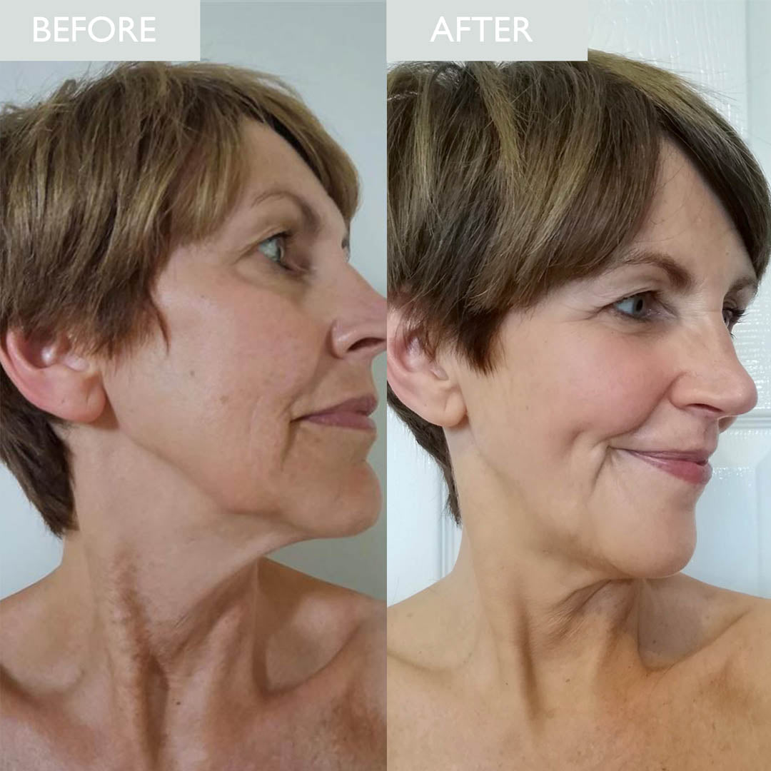 SKINICIAN Restoring Night Cream before and after on a lady with noticeable ageing improvements.