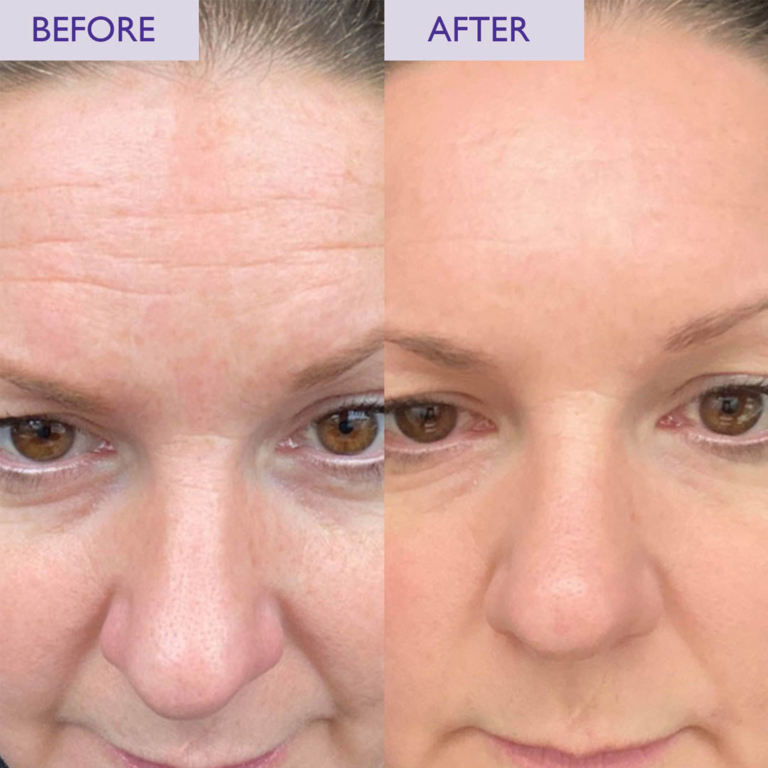 Before and after image of a lady having used SKINICIAN anti ageing cream with retinol and peptides
