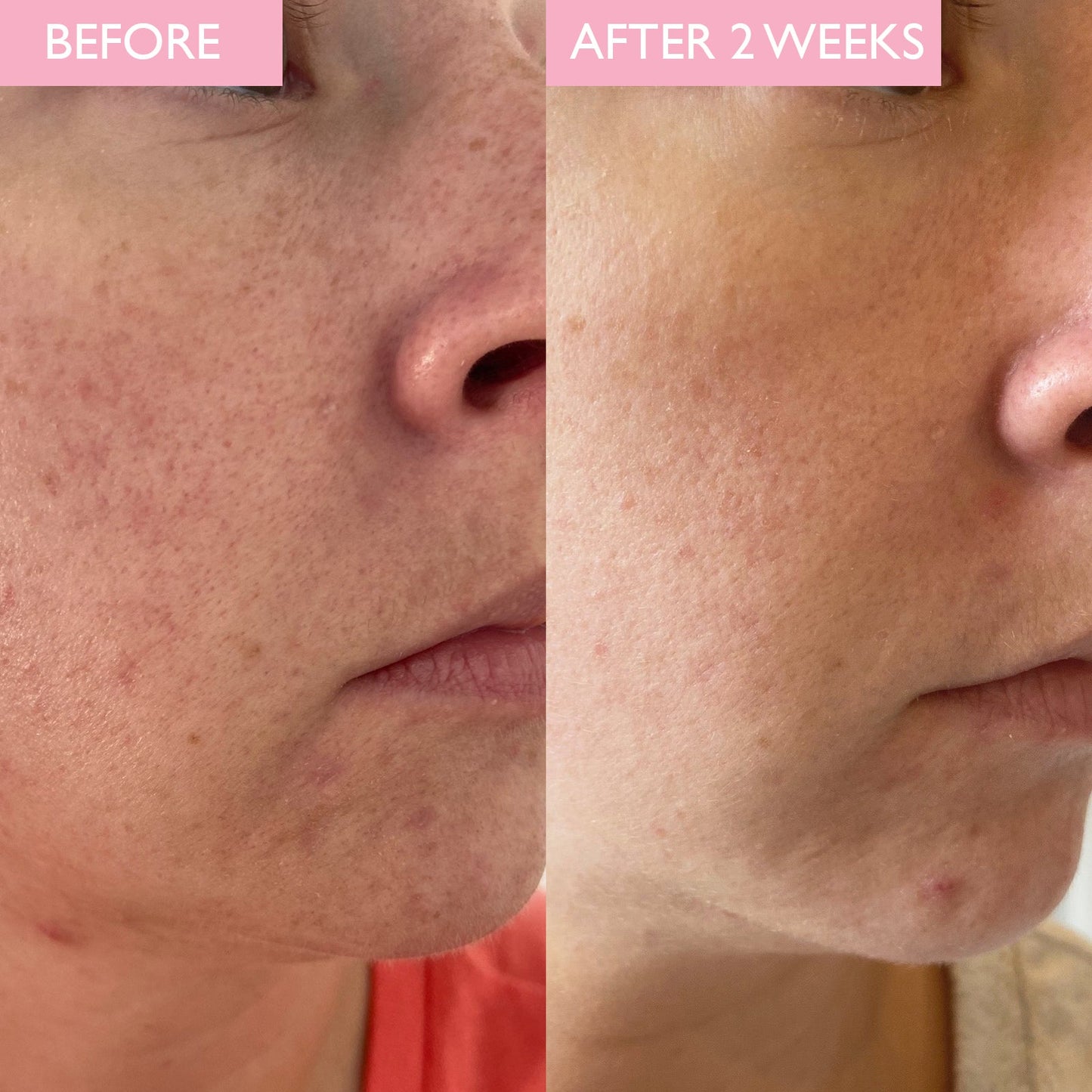 Before and After image of skin improvements from using the revitalising cleanser with grapeseed oil, chamomile and green tea.