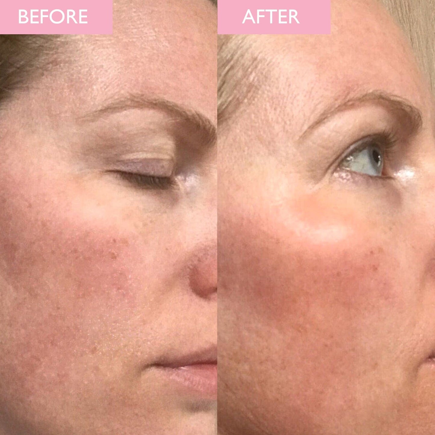 Revitalising toner before and after image on a lady, results show brighter and more luminous skin.