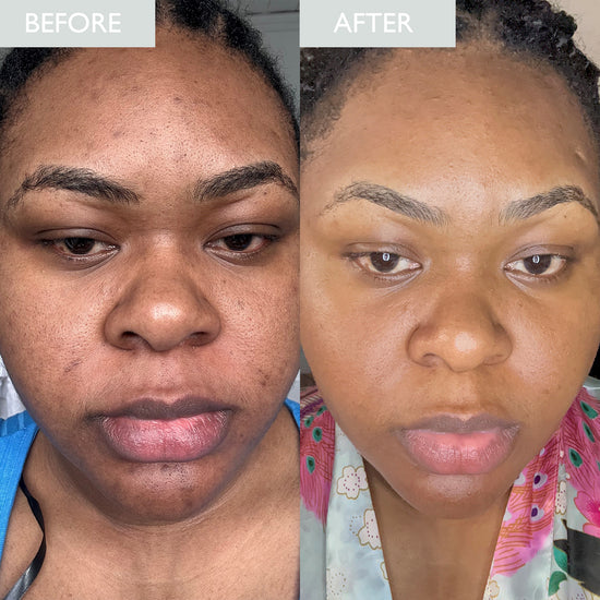 before and after image showing an improvement in hyperpigmentation after using SKINICIAN products for 6 weeks