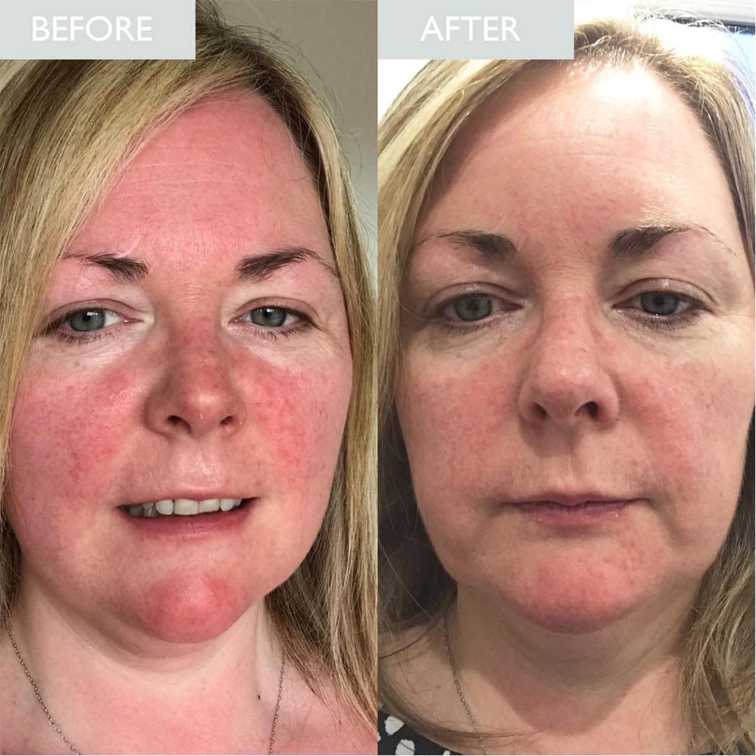 Before and after of a lady having used the sensitive calming serum on red and inflammed skin.