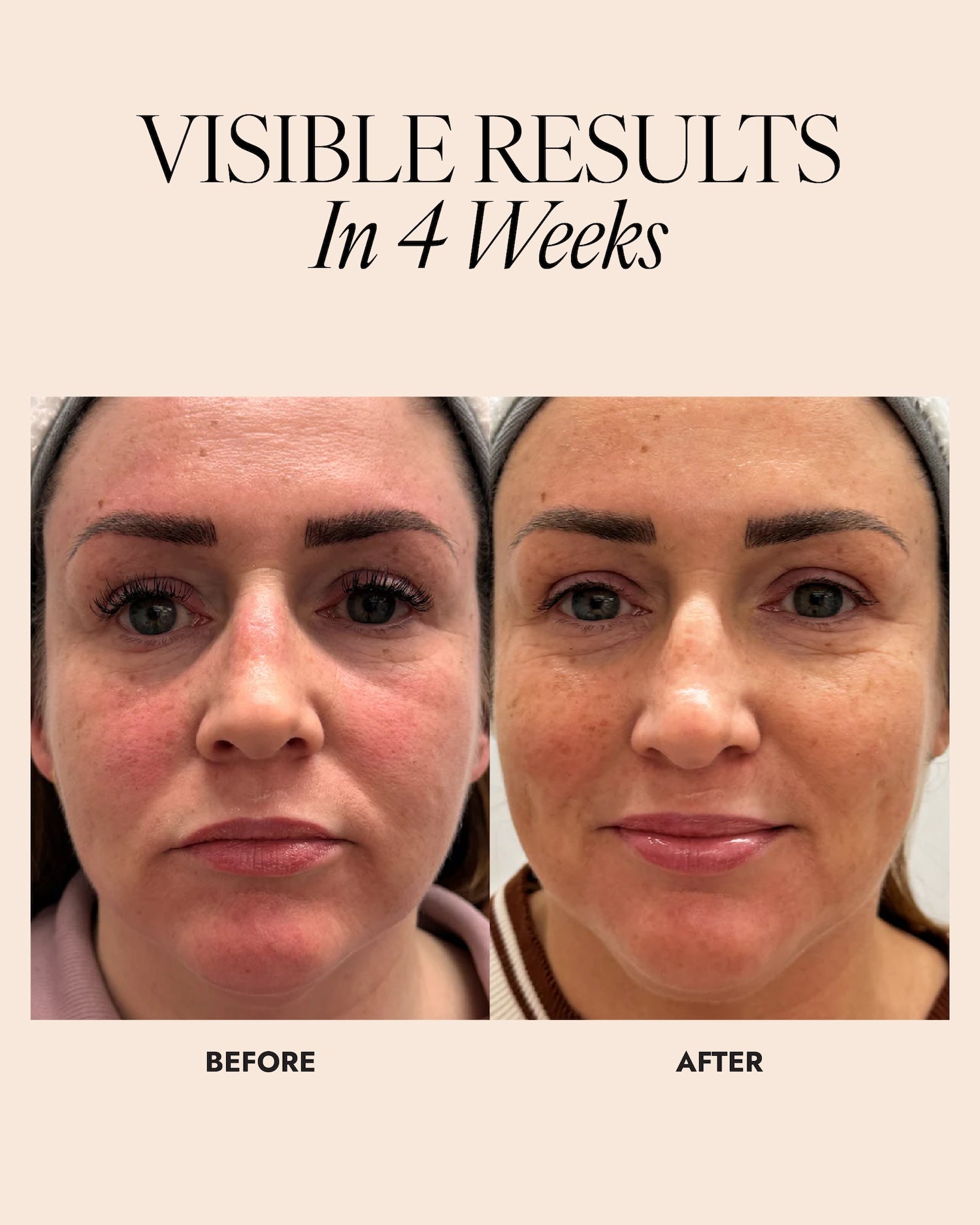 Before and after comparison of a woman's face showing a reduction in skin redness after 4 weeks.