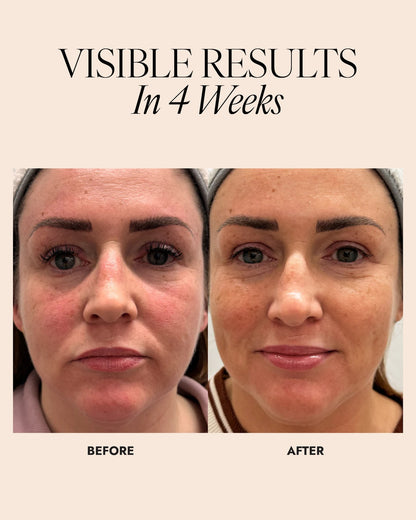Before and after comparison of a woman's face showing a reduction in skin redness after 4 weeks.