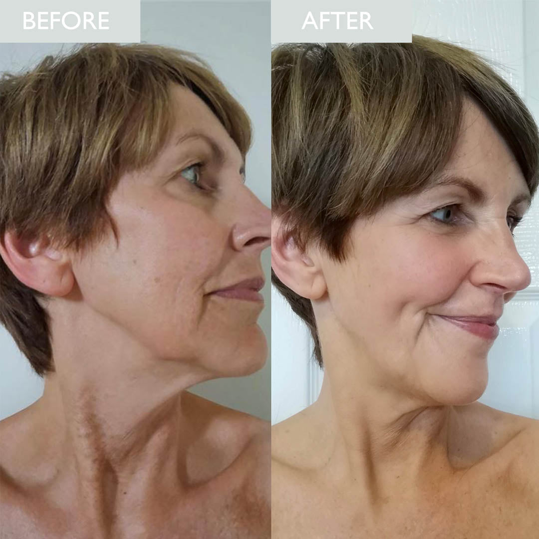 Before and after picture of a lady who used Advanced Time Delay Day Cream with SPF30