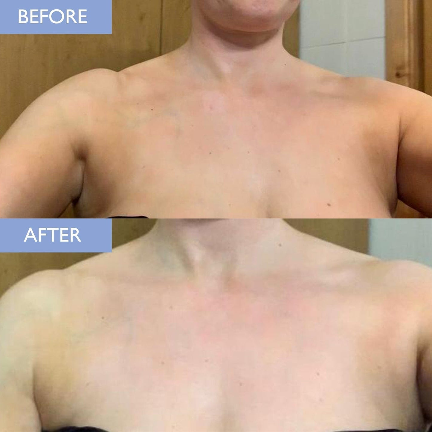 Image showing a before and after using exfoliating body scrub on the chest area.  Clearer, brighter skin is displayed.