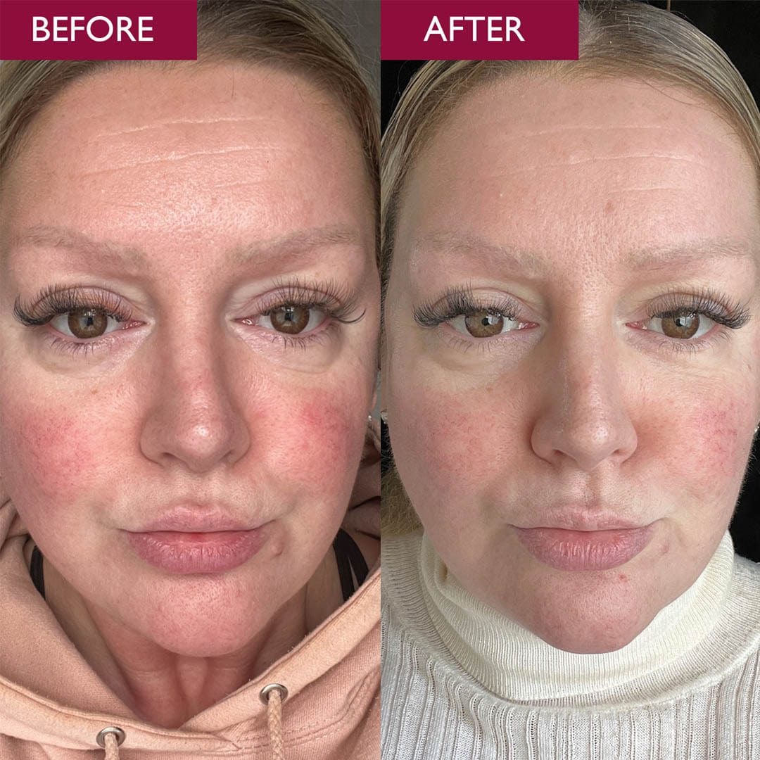 Before and after image of a ladies face, after using advanced calming serum for redness