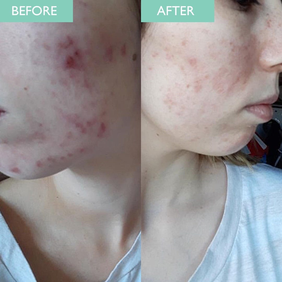 Acne prone skin face kit before and after picture. Shows improvement on acne breakout on female face
