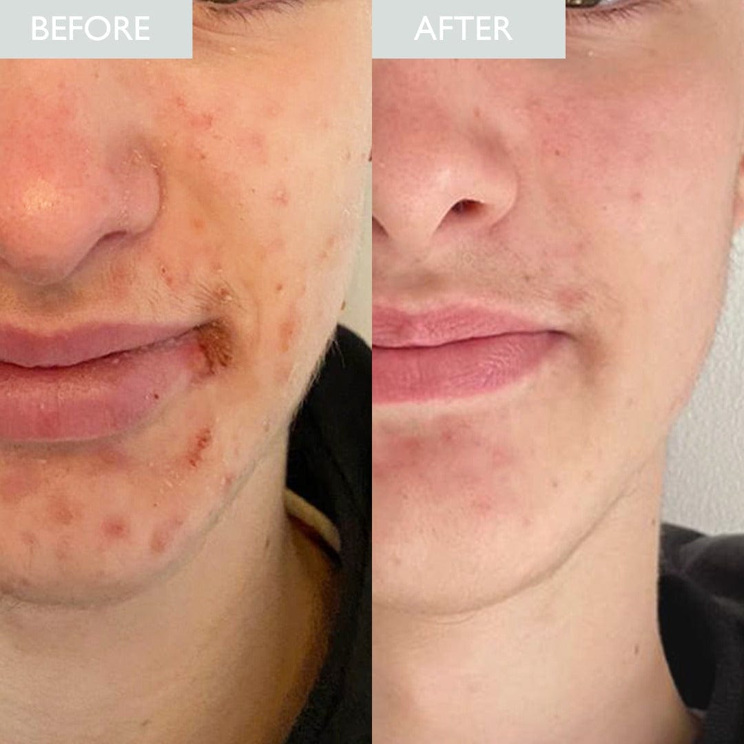 Before and after picture showing a male face with improvement in acne after using this skincare kit for acne prone skin