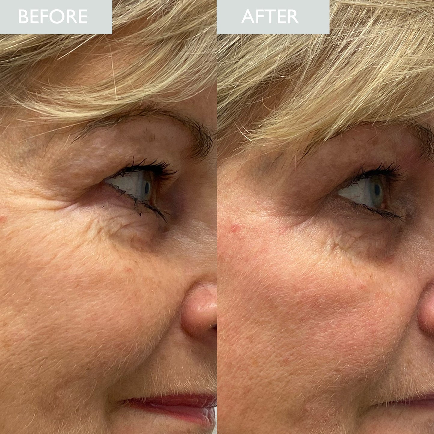 Woman showing before and after demonstrating a reduction in lines around eye area